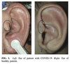 An Auricular Marker for COVID-19. Citation: (Volf 2020, 174)