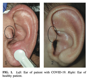 Observing and Using Auricular Visual Markers in Patients with COVID-19